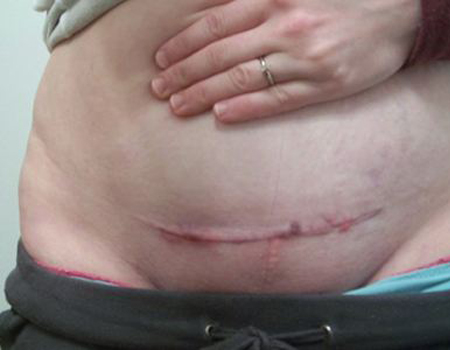 女人剖腹产之后腰疼,女人剖腹产之后的文案