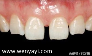 门牙有缝的女人有什么不好,门牙有缝怎么办