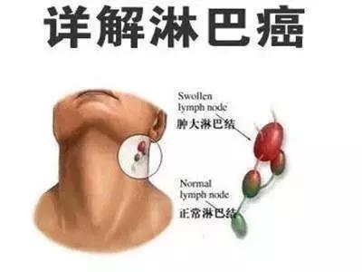 全世界癌症什么时候可以治愈,2017年世界癌症日正确认识癌症