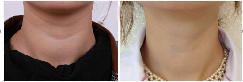 黄金微针祛除颈纹,去除颈纹的微针视频