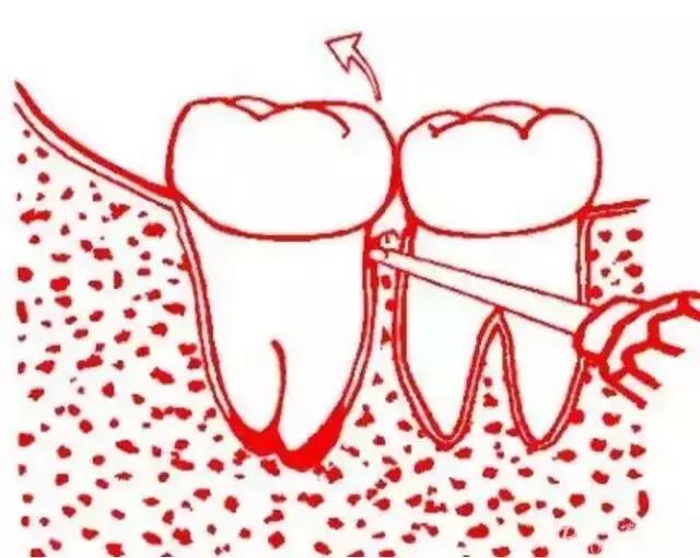 智齿的治疗过程,智齿要上下成对拔除吗