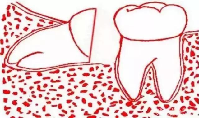 智齿的治疗过程,智齿要上下成对拔除吗