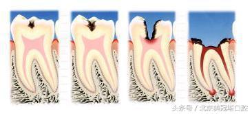 说清楚到底是什么意思,有几种原因引起牙疼