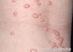 小孩传染性软疣冷冻后变成了水泡,儿童常见皮肤病疣