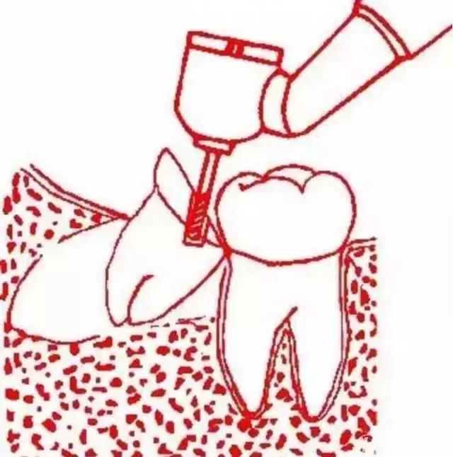 智齿的治疗过程,智齿要上下成对拔除吗