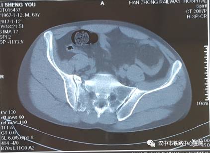 骨盆髋臼骨折内固定手术,骨盆骨折空心螺钉固定器械