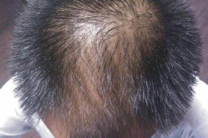 秃顶重头长头发太细怎么改善,秃顶头发稀少怎样掩饰