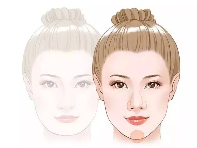 玻尿酸填充下巴一针还是两针好,玻尿酸丰下巴后要关注哪些问题