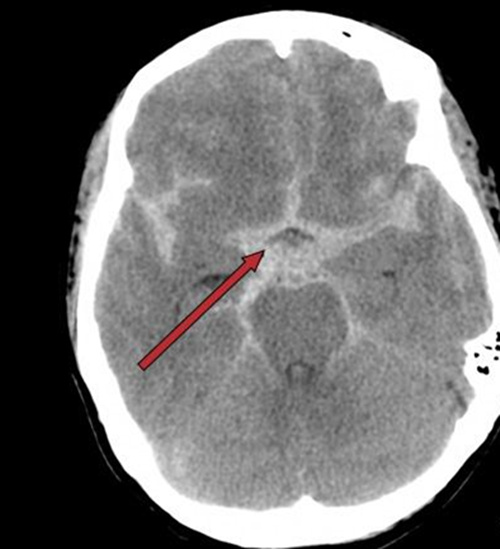 老年人头痛想吐什么原因,中老年人头晕想呕吐什么原因