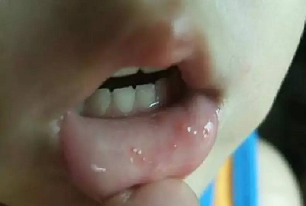 男孩高烧不退被医生发现,3岁男孩高烧不退