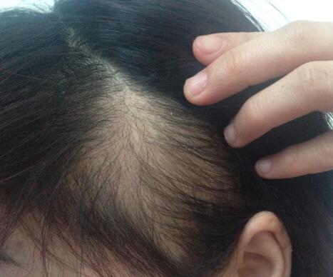秃顶重头长头发太细怎么改善,秃顶头发稀少怎样掩饰