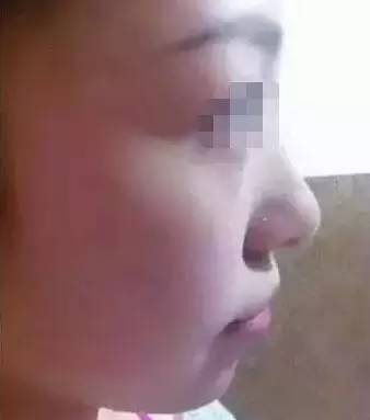 玻尿酸填充下巴一针还是两针好,玻尿酸丰下巴后要关注哪些问题