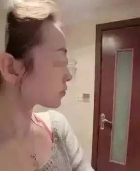 玻尿酸填充下巴一针还是两针好,玻尿酸丰下巴后要关注哪些问题