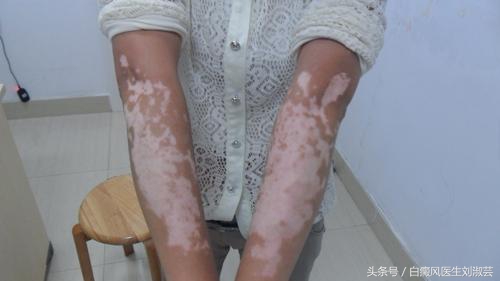 白癜风能自愈吗视频,白癜风能治愈吗白癜风怎么引起的