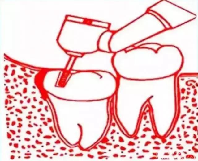 智齿的治疗过程,智齿要上下成对拔除吗