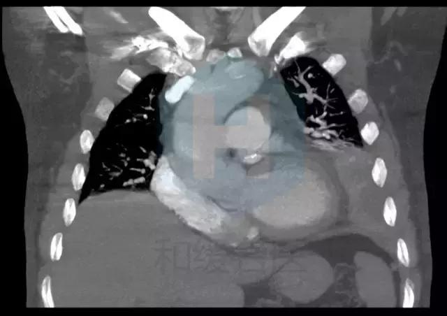 心脏支架后还有胸痛的症状怎么办,心脏支架后还是心绞痛是什么原因