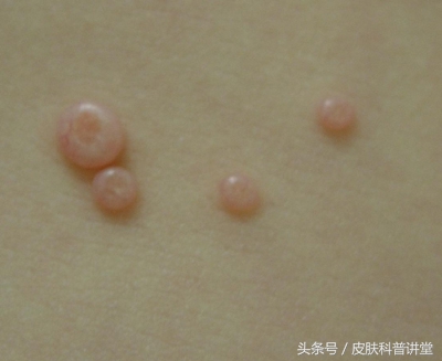 小孩传染性软疣冷冻后变成了水泡,儿童常见皮肤病疣