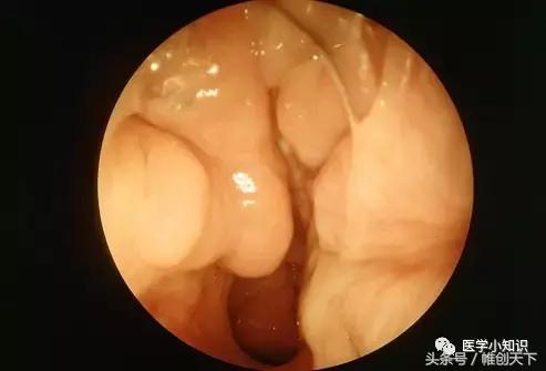 鼻窦炎图片和治疗方法,副鼻窦炎最好的治疗方法