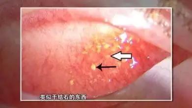 眼睛里有结石是不是容易发炎,眼睛长结石有什么症状