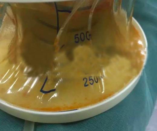 25岁男孩吃外卖吃出胃癌,长期吃泡面会胃穿孔吗