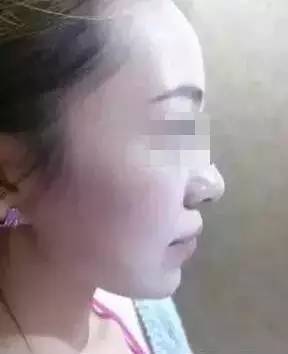 玻尿酸填充下巴一针还是两针好,玻尿酸丰下巴后要关注哪些问题