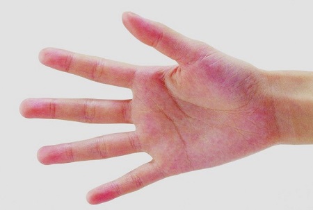 手掌红斑肝脏问题,手掌红眼睛红