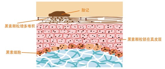 激光治疗胎记彻底吗,激光治疗胎记有副作用吗