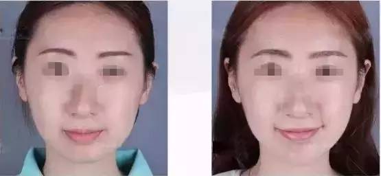 玻尿酸填充下巴一针还是两针好,玻尿酸丰下巴后要关注哪些问题