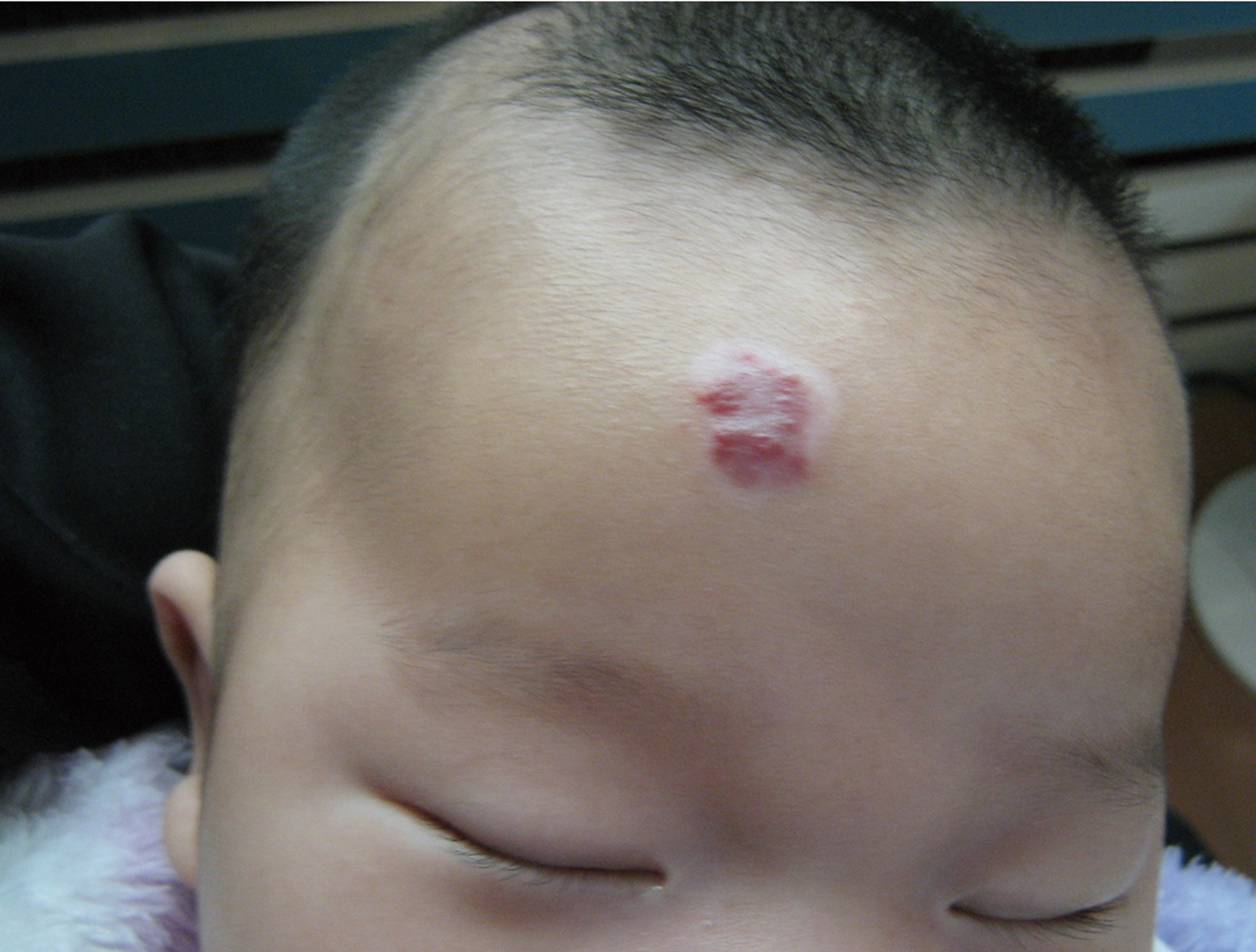 新生儿额头有块红的是啥,新生儿额头出现一片泛红