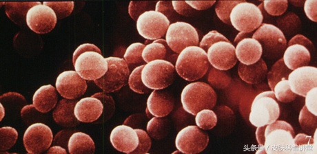 一张图教你辨别脓疱疮,皮肤内脓疱疮最快根除方法