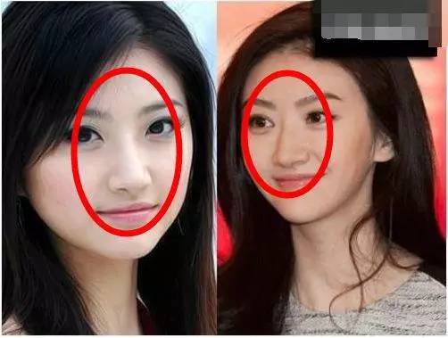 双眼皮怎么割没肉条感,双眼皮怎么显得更宽