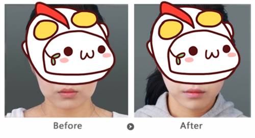 玻尿酸填充下巴一针还是两针好,玻尿酸丰下巴后要关注哪些问题