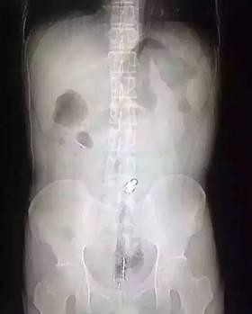 杭州男子肛门被塞20公分长振动棒称年会被恶搞（图