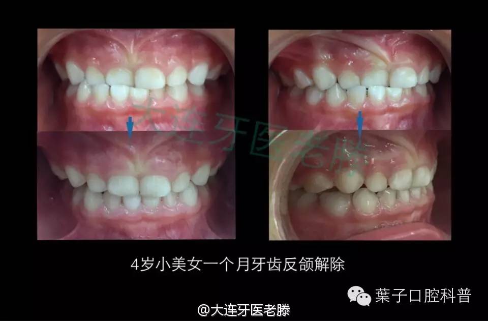 儿童反颌矫正的年龄及步骤,儿童反颌偏颌矫正案例
