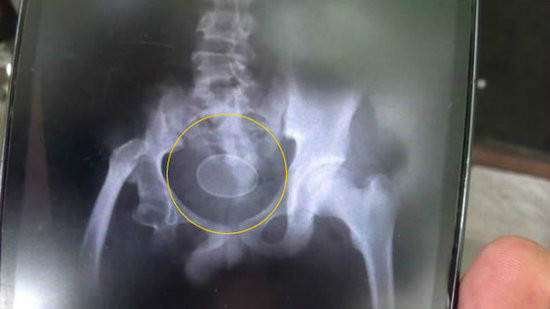 杭州男子肛门被塞20公分长振动棒称年会被恶搞（图