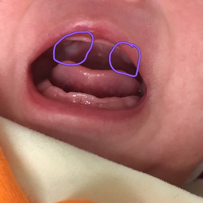 新生儿常见疾病有哪些,新生儿常见疾病及表现