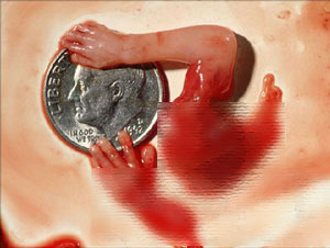 人流手术中胎儿是怎么被取出来的？看了这几张图片你还狠得下心吗