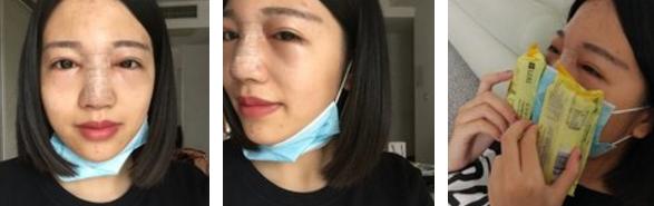 隆鼻后鼻子歪了如何手法矫正,硅胶隆鼻有点歪修复需要再付费吗