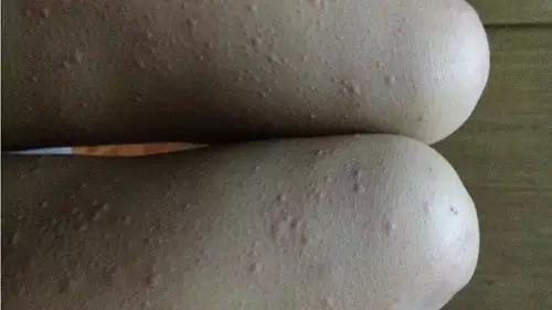 慢性*麻疹荨**de自愈，不可治愈