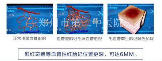 为什么说靠药品去除不了胎记