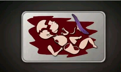 人流手术中胎儿是怎么被取出来的？看了这几张图片你还狠得下心吗