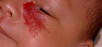 毛细血管瘤的形成原因,婴儿毛细血管瘤的原因