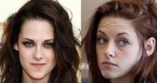 18岁比较深的抬头纹怎么去除,为什么很年轻就有抬头纹