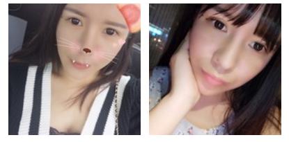 鼻子玻尿酸对比图,玻尿酸填充鼻子变宽后的图片