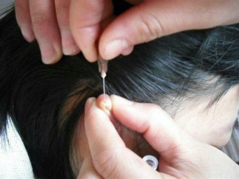 眼麦粒肿中医最快消除办法,中医治疗麦粒肿怎么治疗好得快