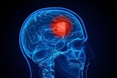 凯美纳治愈肺癌案例,凯美纳治疗晚期肺癌的效果