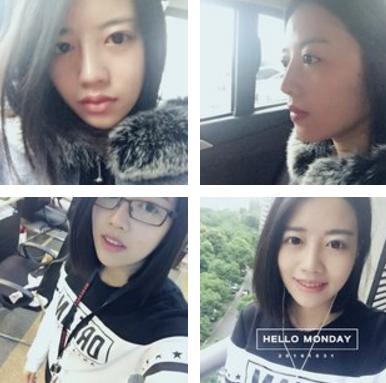 隆鼻后鼻子歪了如何手法矫正,硅胶隆鼻有点歪修复需要再付费吗