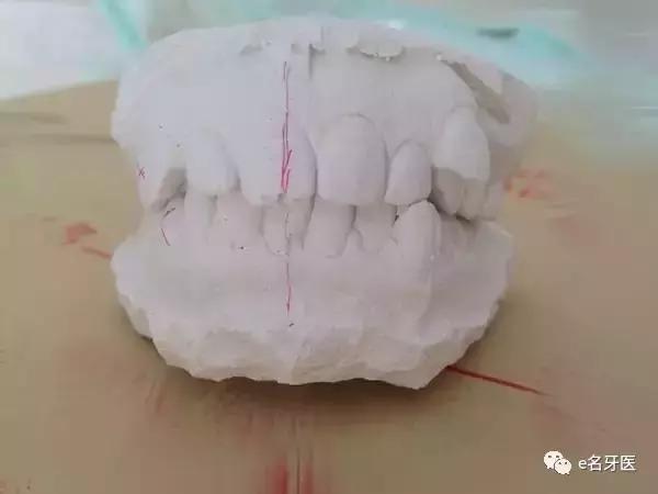 有牙洞并感觉到疼痛了,有牙洞很疼怎么办