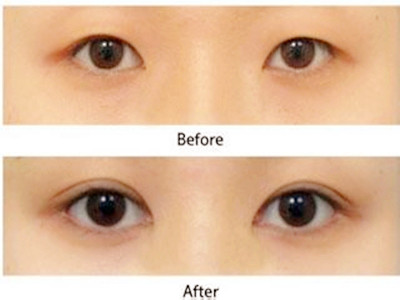 割双眼皮后多久可以吃辣,割双眼皮后多久可以吃辣椒