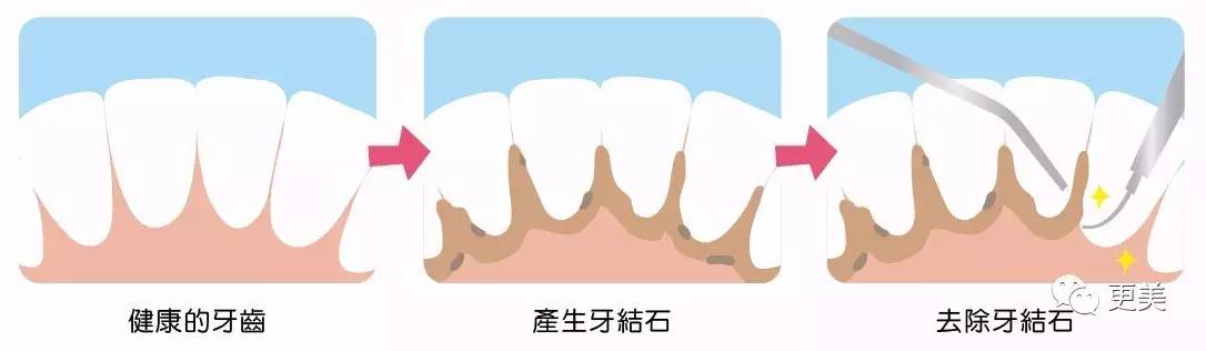 洗牙后牙缝变大松动错位,洗牙后牙齿松动的的亲身经历